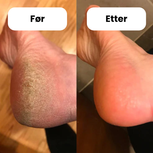 FeetCARE PRO™ | Fjerner Hard Hud Raskt & Effektivt